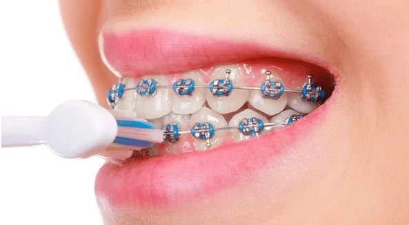 brushing teeth with braces
