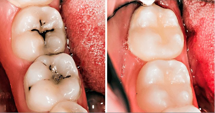 What is tooth decay, and how can I prevent it?