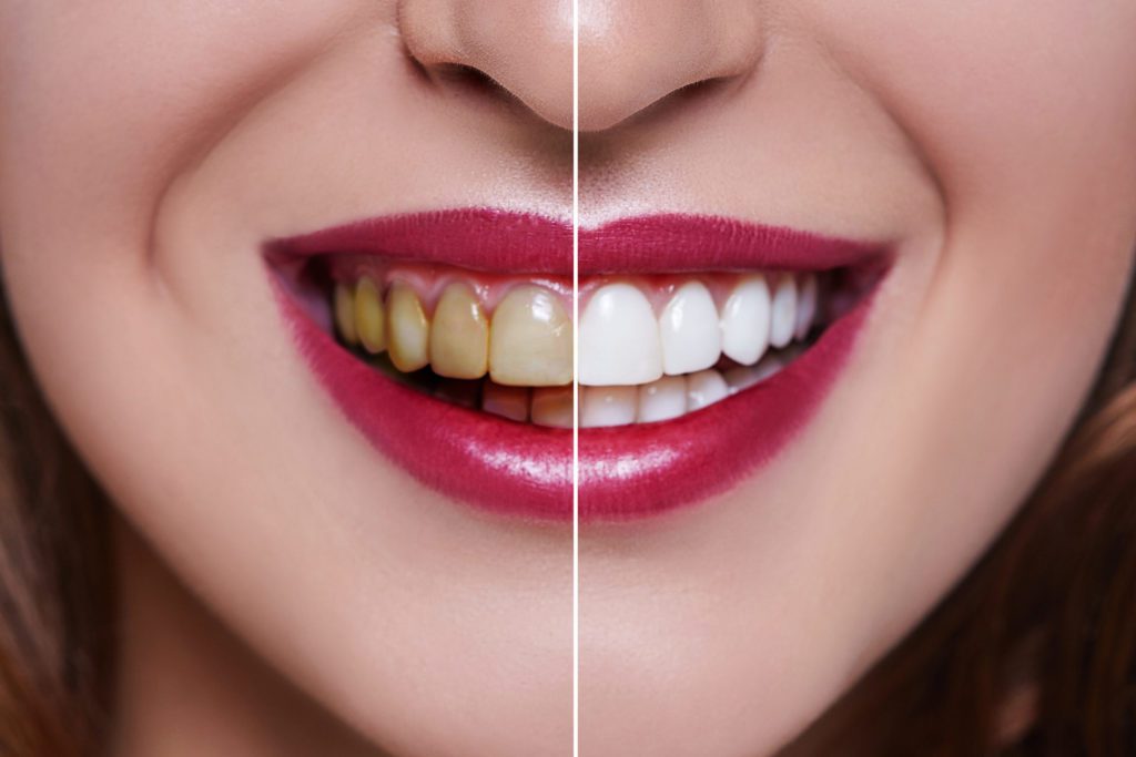 What Are Veneers? All You Need to Know